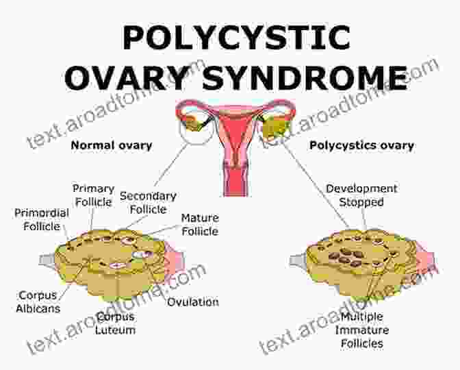 Infertility In Women With Polycystic Ovary Syndrome Infertility In Women With Polycystic Ovary Syndrome: Pathogenesis And Management