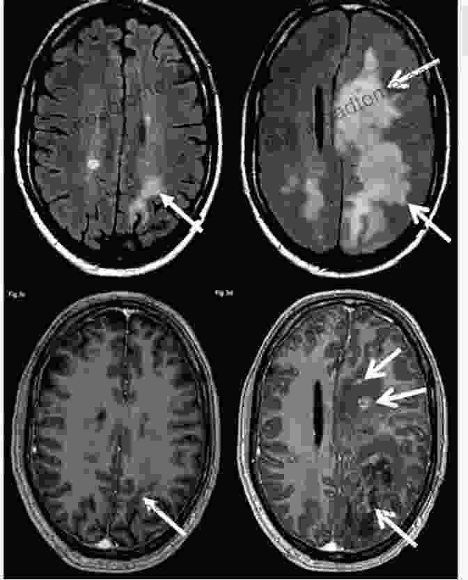 MRI Scan Showing Lesions In The Brain Of A Person With MS Understanding Multiple Sclerosis (Understanding Health And Sickness Series)