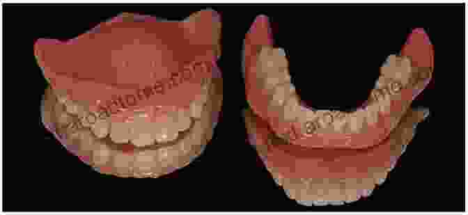 Types Of Dentures Prosthetic Treatment Of The Edentulous Patient