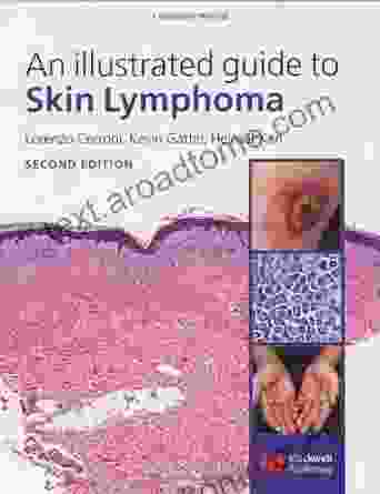 An Illustrated Guide To Skin Lymphoma