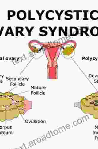 Infertility in Women with Polycystic Ovary Syndrome: Pathogenesis and Management