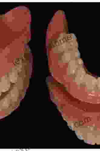 Prosthetic Treatment Of The Edentulous Patient