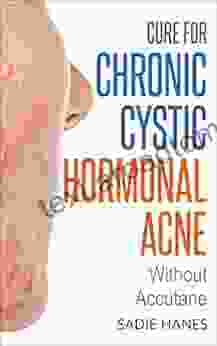 Cure For Chronic Cystic Hormonal Acne : Without Accutane (Healthy Hormones)